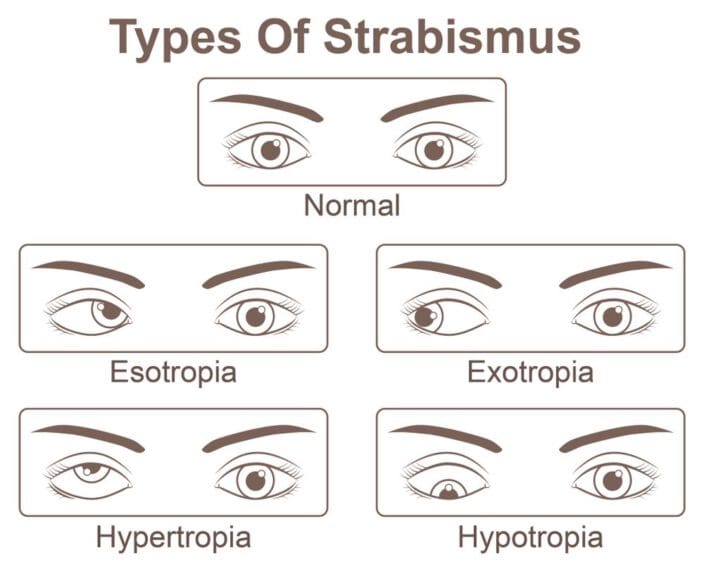 types of strabismus