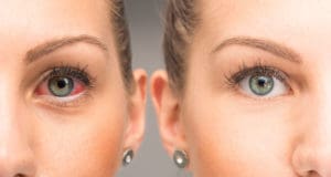 woman red irritated eye compared to her normal eye